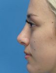 after rhinoplasty left side view female patient case 5210