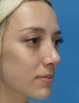 after rhinoplasty right angle view female patient case 5210