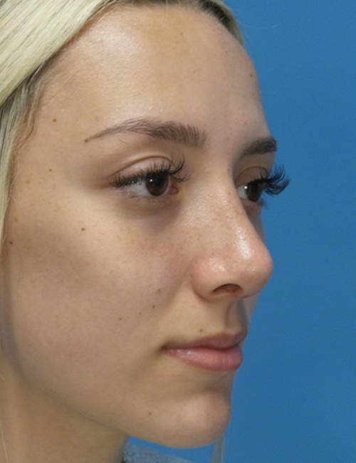 after rhinoplasty right angle view female patient case 5210