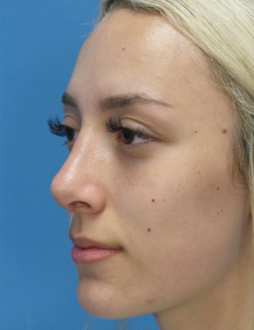 after rhinoplasty left angle view female patient case 5210