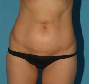 before tummy tuck front view female patient case 5166
