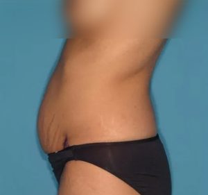 before tummy tuck left side view female patient case 5167
