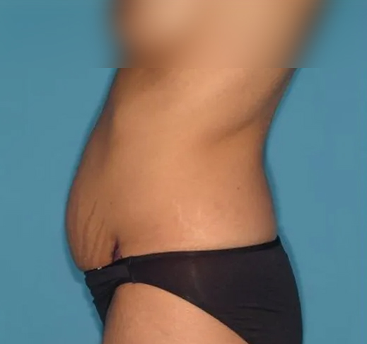 before tummy tuck left side view female patient case 5167