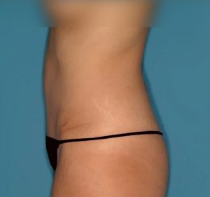 after tummy tuck left side view female patient case 5167