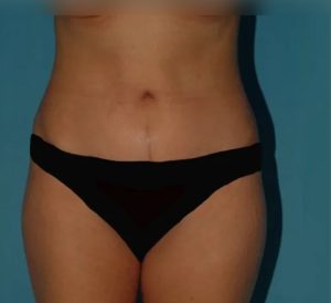 after tummy tuck front view female patient case 5166