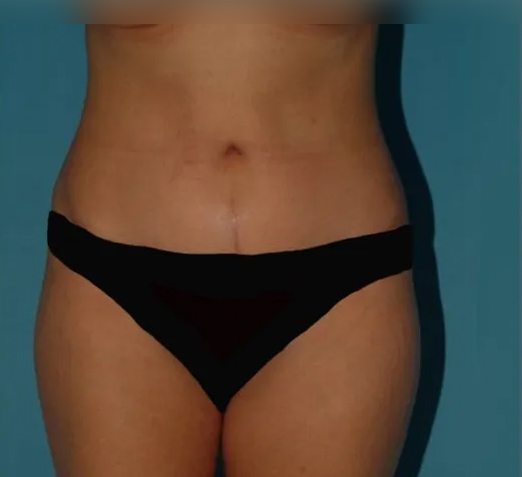 after tummy tuck front view female patient case 5166